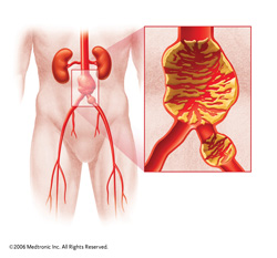 abdominal_aortic_aneurysm