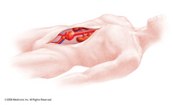 abdominal_aortic_aneursym_s