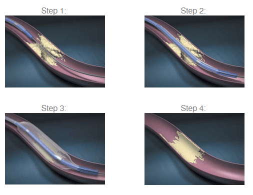 cardiology interventional treatment diagram