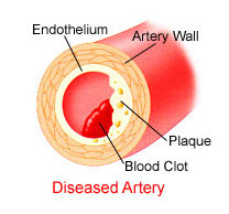 diseased artery cutaway