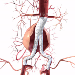 endurant-stent