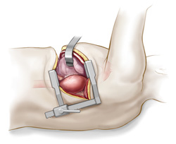 thoracic_aortic_aneursym_su