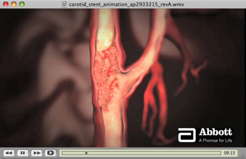 carotid stent animation